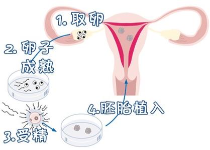 取卵手术室